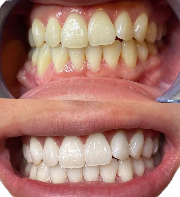 Professional teeth whitening result